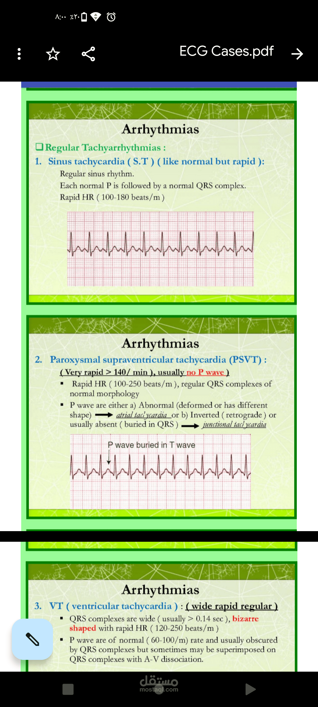 محاظرة بعنوان ECG Cases