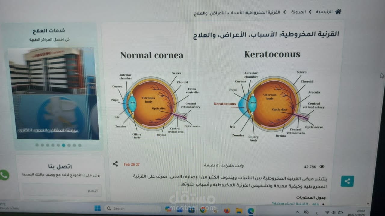 القرنية المخروطية الأسباب الأعراض العلاج