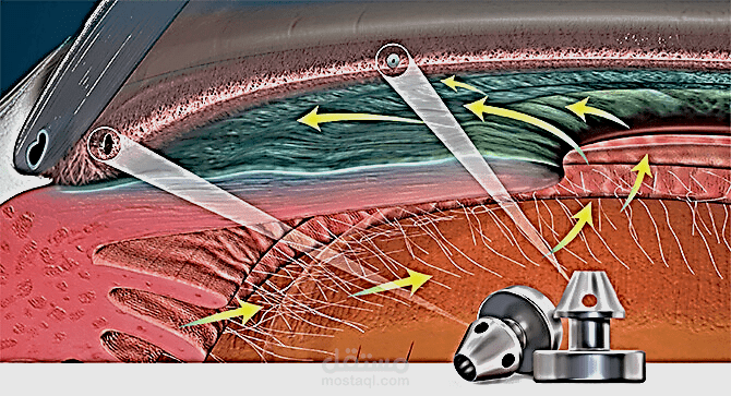 Advancements in Minimally Invasive Glaucoma Surgery: Techniques, Devices, and Clinical Outcomes