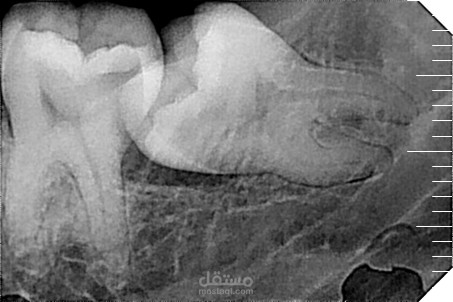 اسباب تسوس الاسنان