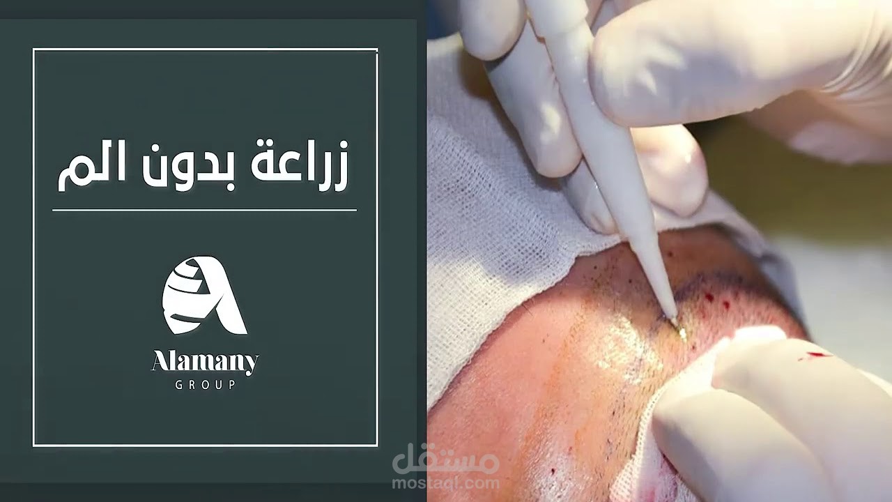 فيديو تسويقي لمركز زراعة الشعر