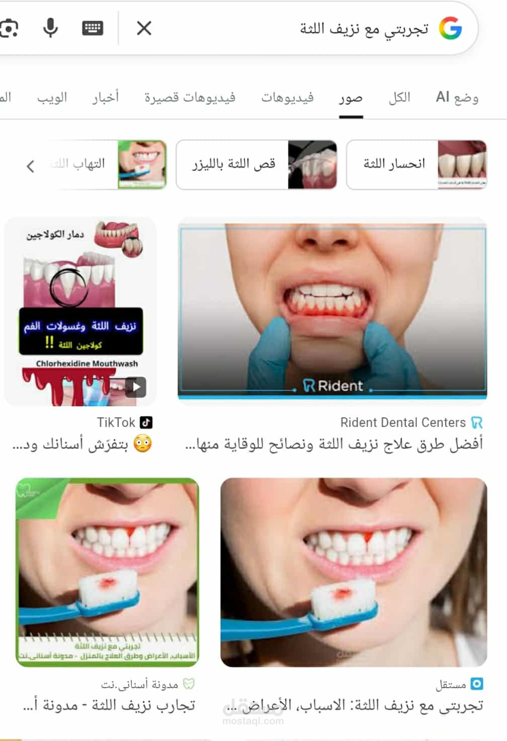 تجربتي مع نزيف اللثة: الاسباب، الأعراض وطرق العلاج بالمنزل