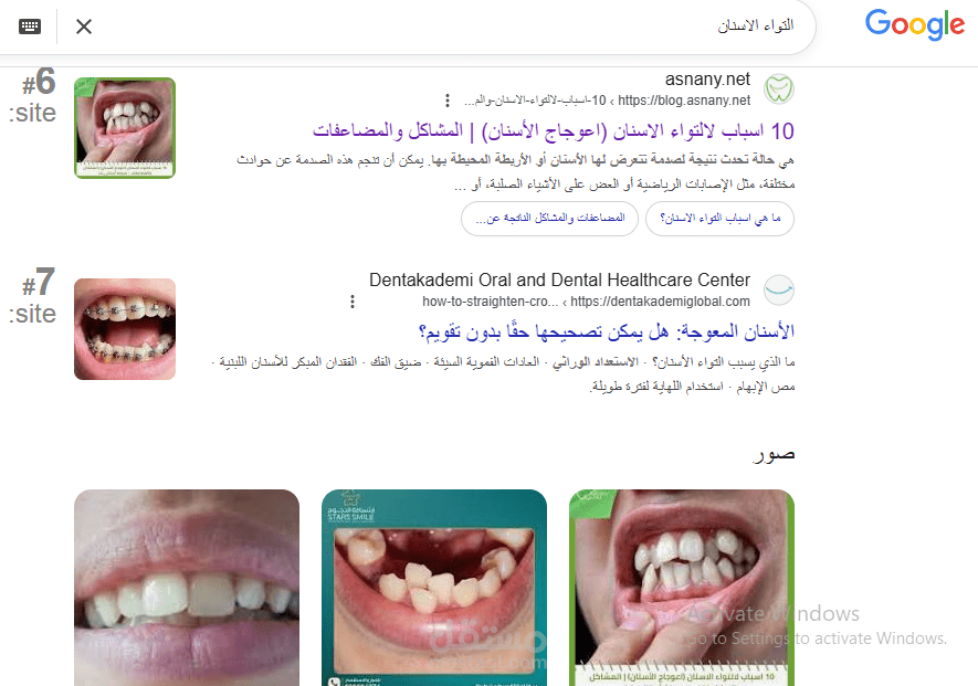 10 اسباب لالتواء الاسنان (اعوجاج الأسنان) | المشاكل والمضاعفات