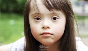 مقاله عن متلازمة داون