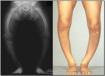 مقال عن مرض الكساح Rickets