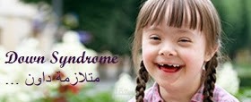 كتابة وترجمة مقالة طبية عن متلازمة داون