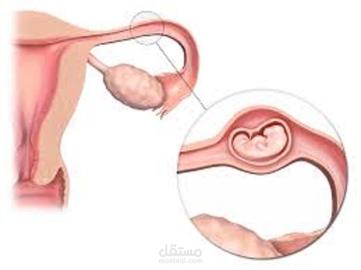 أعراض الحمل خارج الرحم