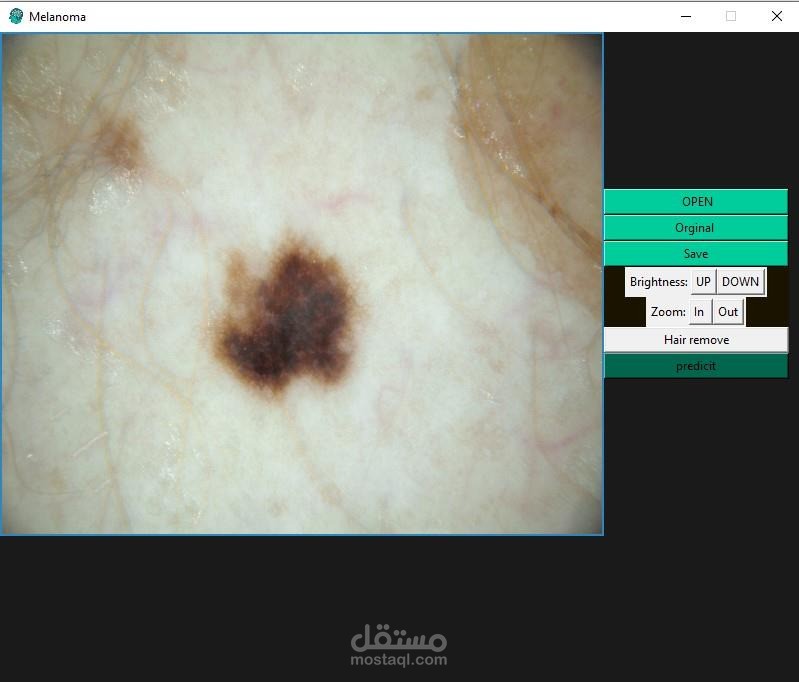 نظام ذكاء اصطناعي  لتشخيص سرطان جلد الميلنوما