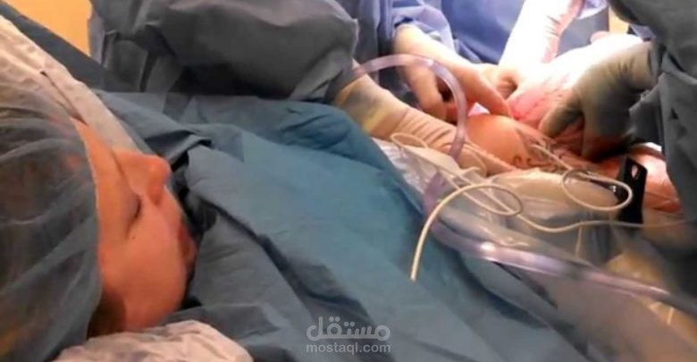 مخاطر الولادة القيصرية على الأم والجنين