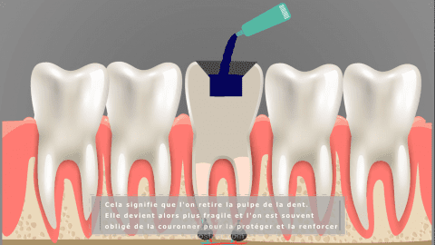 Motion graphics explains how to remove caries