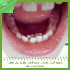 ظاهرة اسنان القرش عند الأطفال (مدونة أسناني)