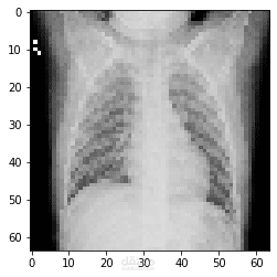 Chest X-Ray Image processing