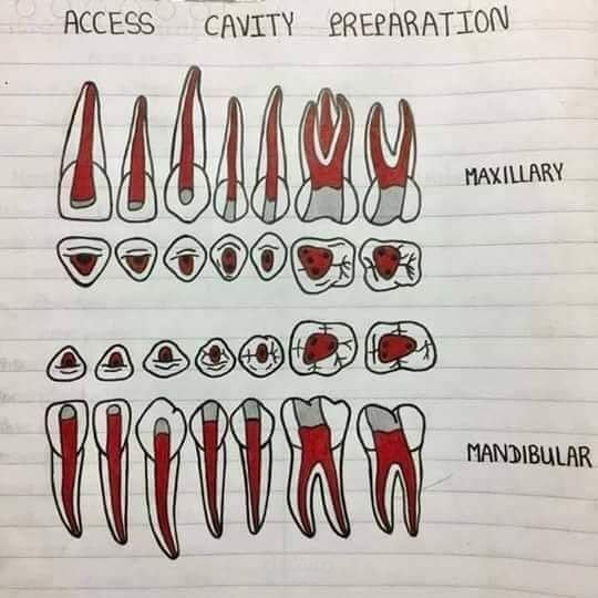 Access cavity preparation
