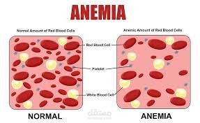 iron-deficiency anaemia