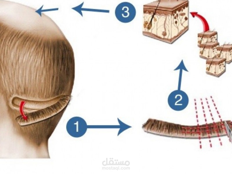 مقالة عن تقنية زراعة الشعر بالطريقة الكلاسيكية