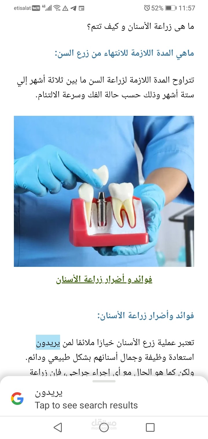 مفال طبي عنوانه ما هى زراعة الأسنان؟ تكلفة زراعة الأسنان، الفوائد والأضرار
