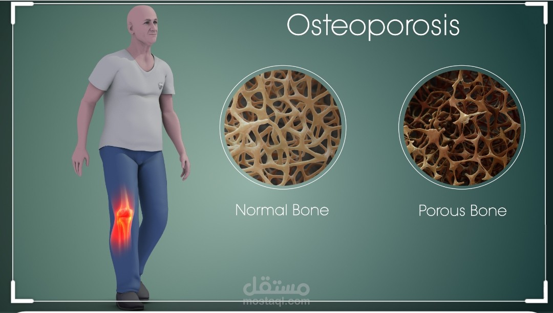 ترجمة مقال علمي عن هشاشة العظام من اللغة العربية إلى الانجليزية