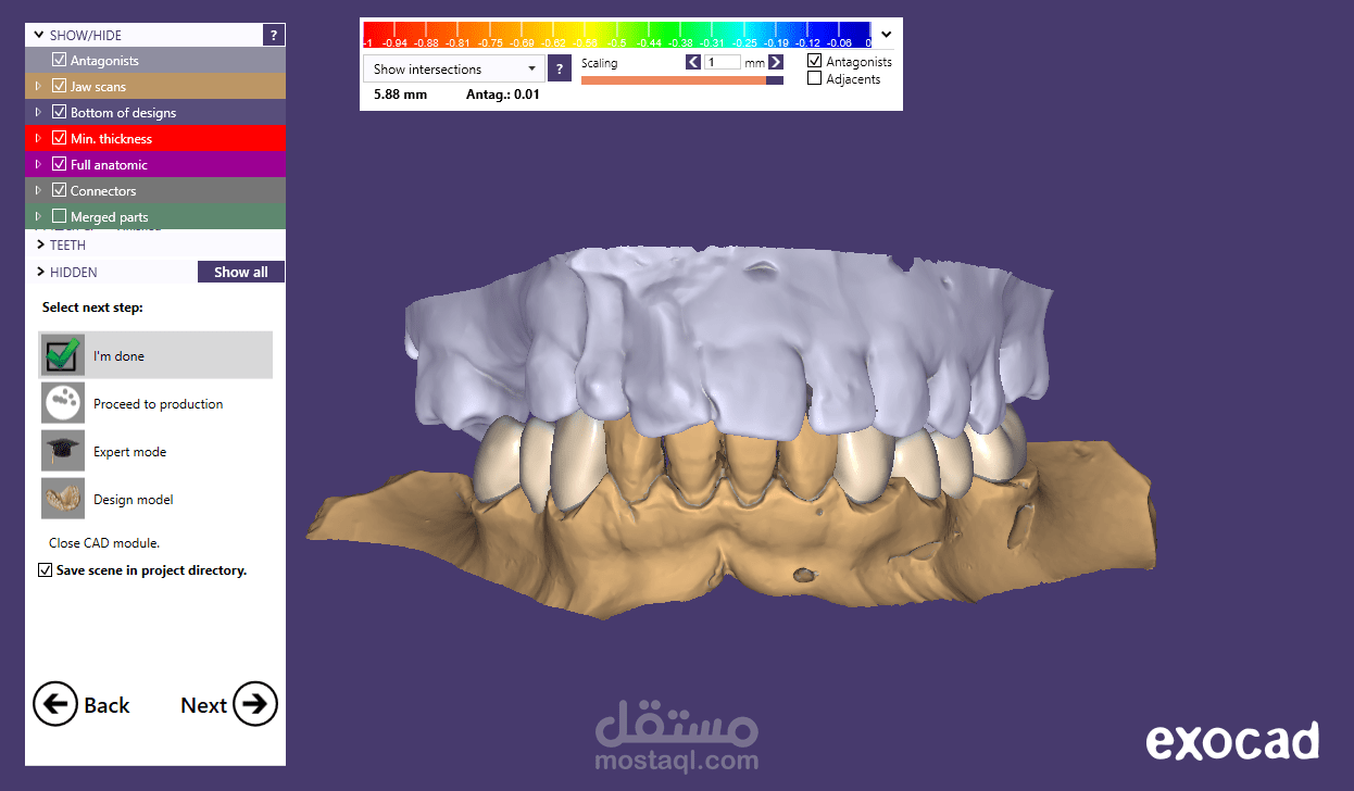 lower arch fixed partial dentures(bridges)