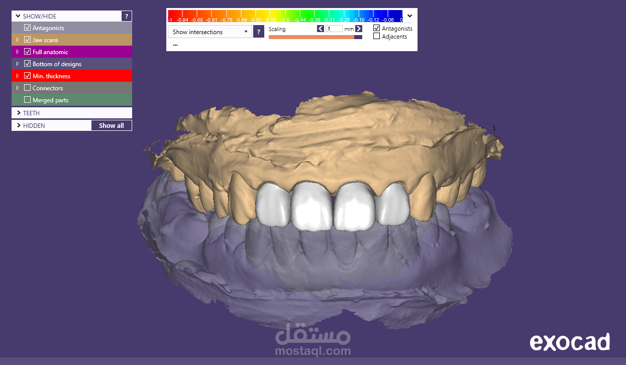 4 upper anterior crowns
