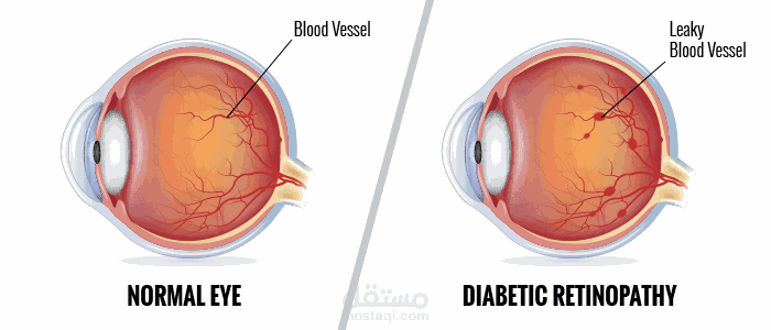 Detection of Diabetic Retinopathy  Using Deep Learning Algorithms