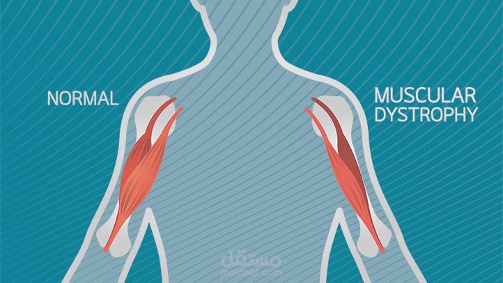 مرض ضمور العضلات (Muscular Dystrophy)