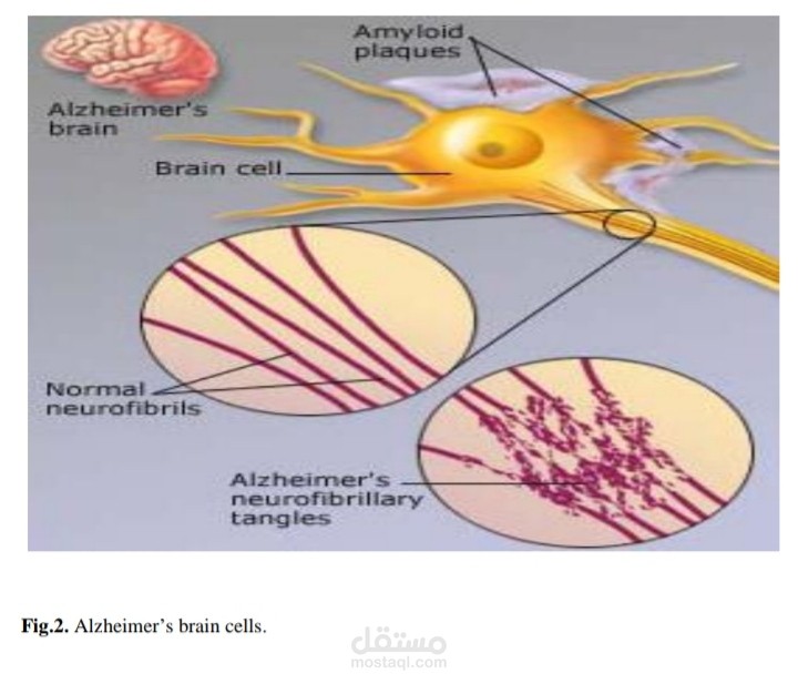 كتابة بحث عن مرض الزهايمر