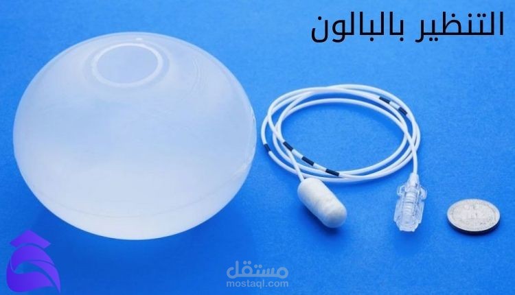 التنظير بالبالون أهم المعلومات المتعلقة