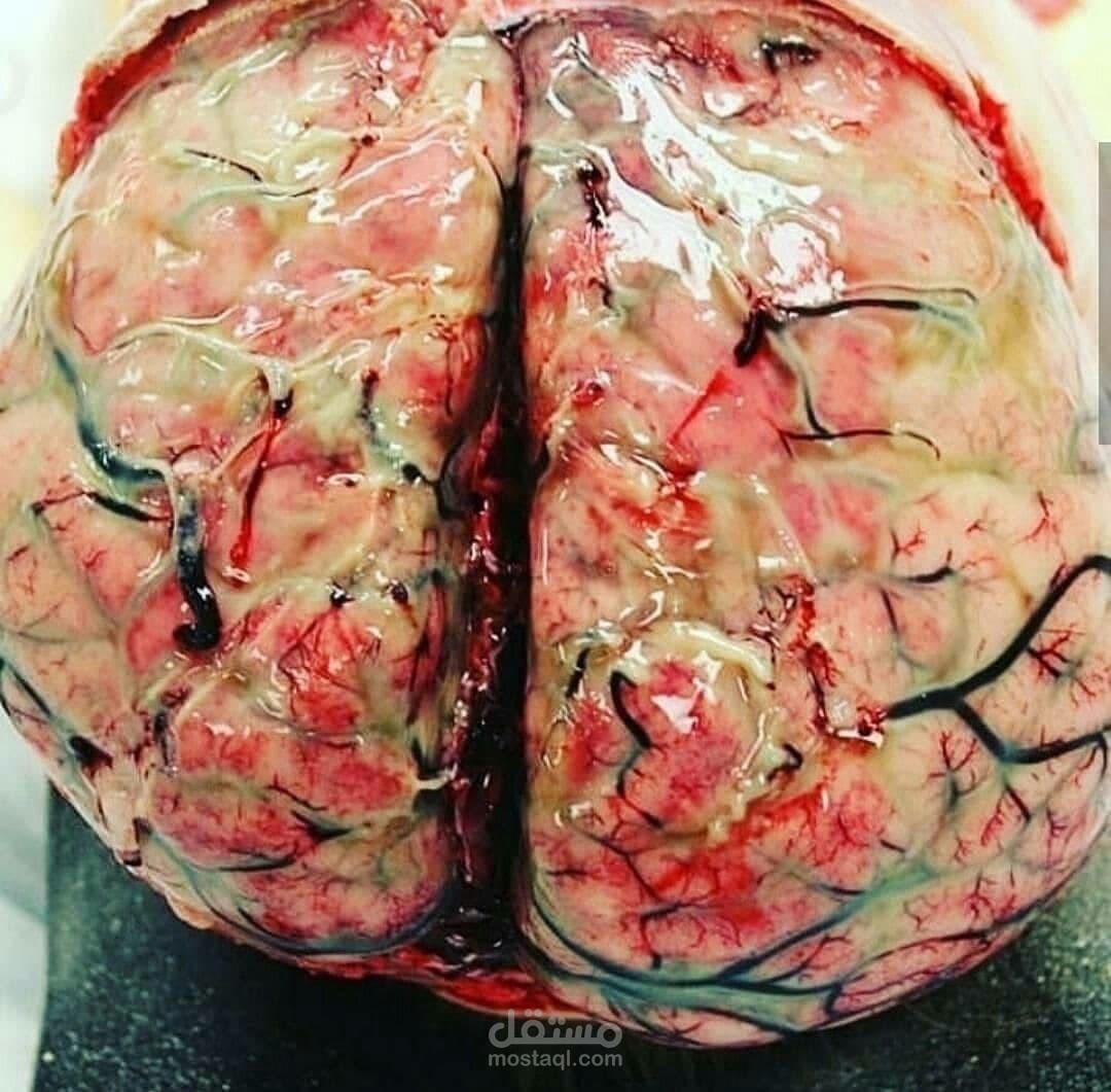 مقالة طبية عن التهاب السحايا