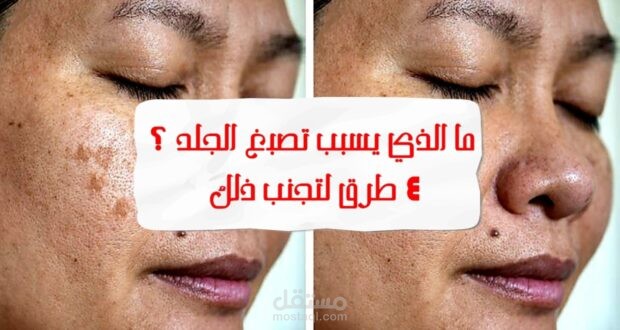 ما الذي يسبب تصبغ الجلد ، و 4 طرق لتجنب ذلك