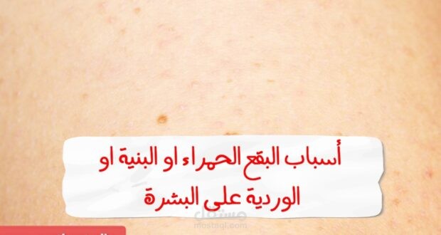 أسباب البقع الحمراء أو الوردية أو البنية على البشرة، وفقًا لأطباء الأمراض الجلدية