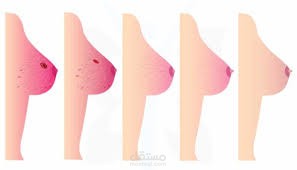 عمليات استئصال الثدي