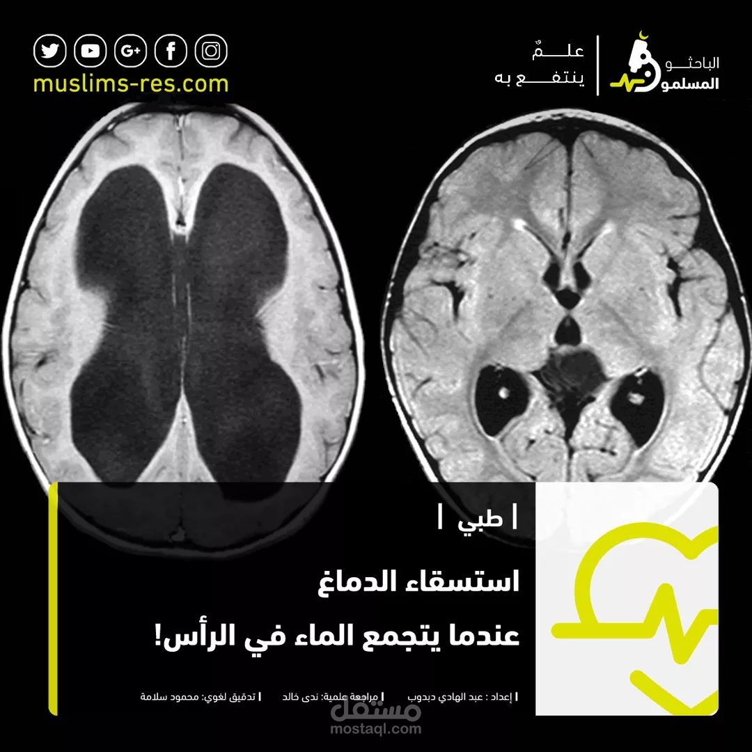 استسقاء الدماغ