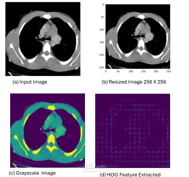 أكتشاف سرطان الرئة المبكر بناءا على بيانات مرضى CTscan مجمعة من المستشفيات